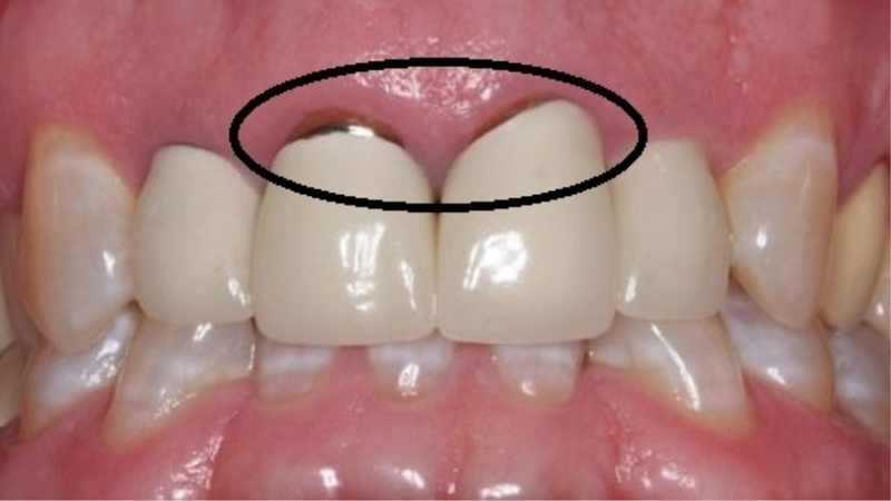 Bọc răng sứ bị thâm lợi - Nguyên nhân và cách xử lý hiệu quả 2 rang su bi den phai lam sao can thiep the nao cho phu hop 2 a035a2e11b