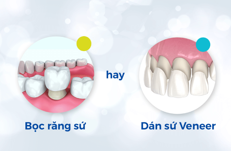 d&aacute;n sứ veneer hay bọc răng sứ