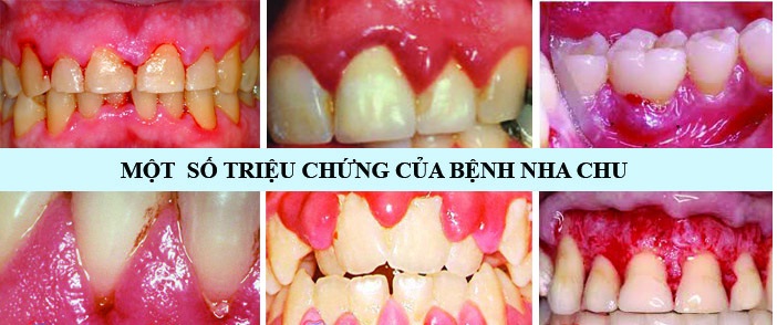 Nguyên nhân, dấu hiệu và cách điều trị viêm nha chu hiệu quả 2 untitled nha chu