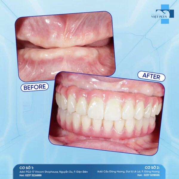 MẤT RĂNG TOÀN HÀM - LÀM SAO ĐỂ PHỤC HỒI CHỨC NĂNG TỐT NHẤT? - 1 7 462