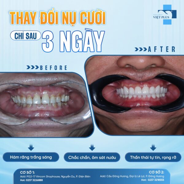 BỌC RĂNG SỨ - THAY ĐỔI NỤ CƯỜI CHỈ SAU 3 NGÀY 1 bocsu1
