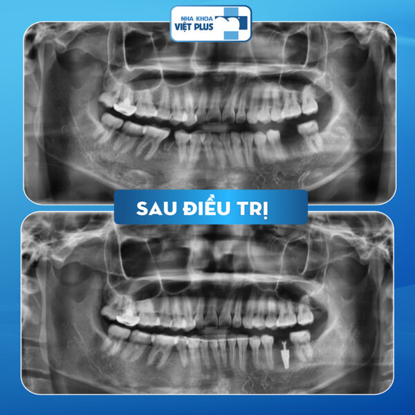 Niềng Răng Kết Hợp Cấy Ghép Implant - Giải Pháp Hoàn Hảo Cho Nụ Cười Đẹp 1 kh