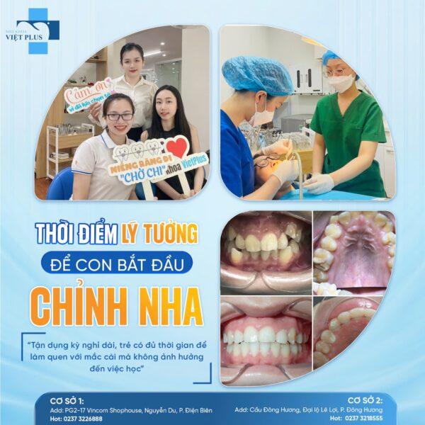 NIỀNG RĂNG MÙA HÈ - THỜI ĐIỂM VÀNG CHO CON TRẺ 4 nr1