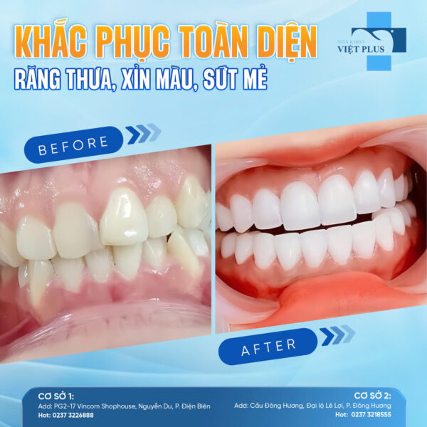 Chỉ cần làm răng sứ thẩm mỹ là đã có thể thay đổi cả nụ cười! 4 rs0