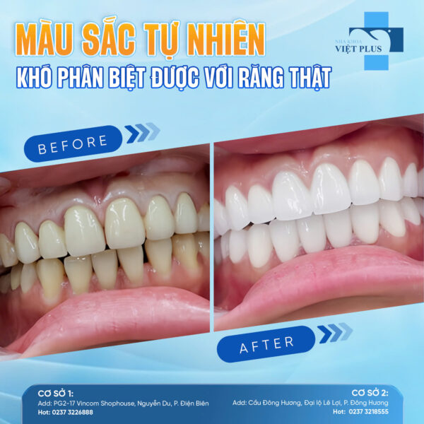 Chỉ cần làm răng sứ thẩm mỹ là đã có thể thay đổi cả nụ cười! 3 rs1