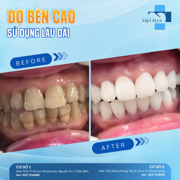 Chỉ cần làm răng sứ thẩm mỹ là đã có thể thay đổi cả nụ cười! 2 rs2