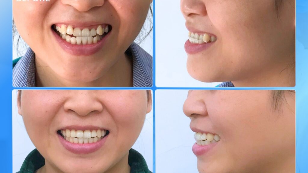 Niềng răng tuổi 33 – Để nụ cười không còn khiến mình e ngại
