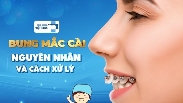 Mắc cài